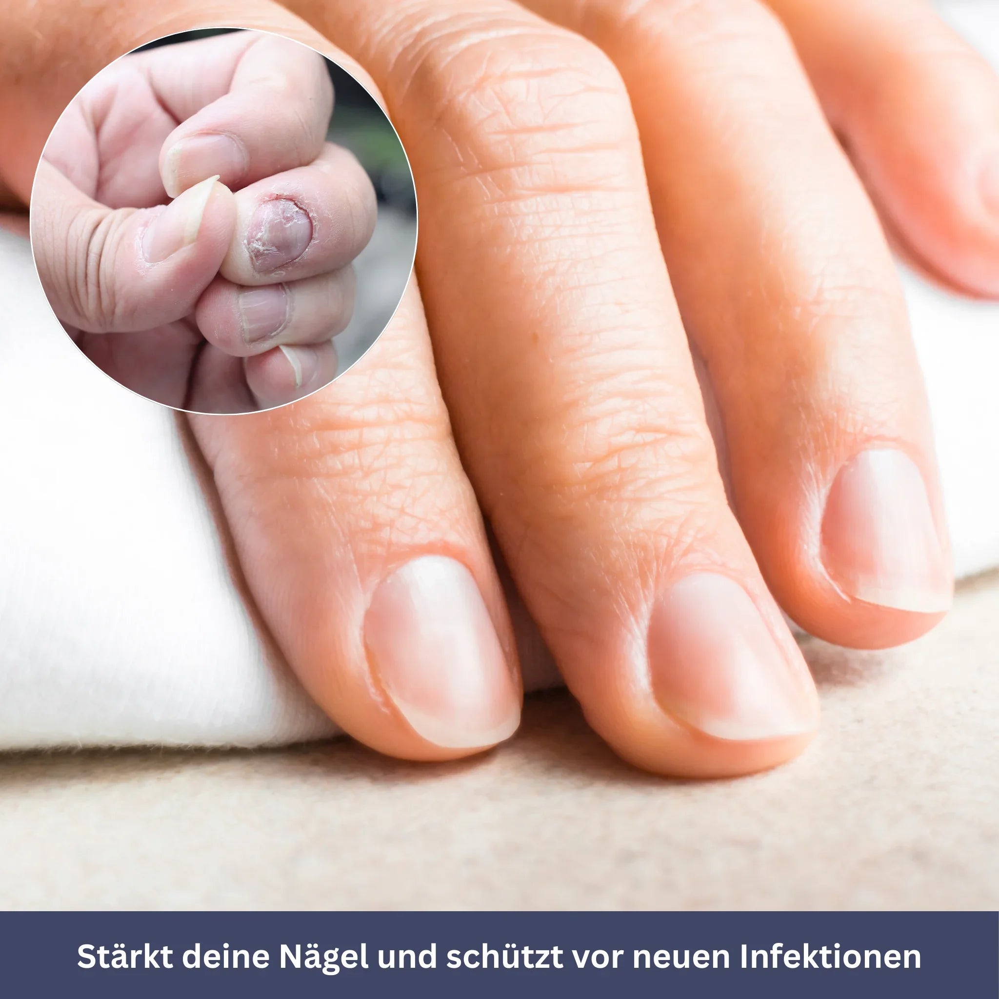 NailPen – Reparaturstift gegen Nagelpilz & Entzündungen